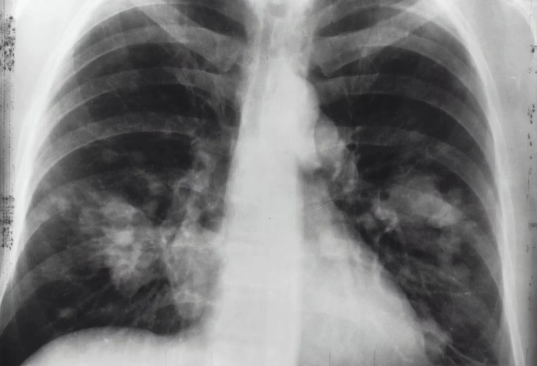 Four Significant Asbestos-Related Diseases and their Symptoms